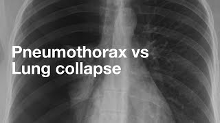 Pneumothorax vs Lung Collapse [upl. by Haye]