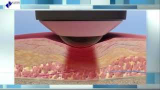 Deep Tissue Laser Therapy The Science Behind Healing [upl. by Gnet]