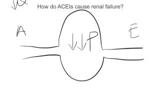 ACEIRenal Failure [upl. by Bolitho]