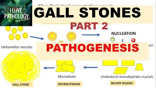 CHOLELITHIASIS GALL STONESPart 2 Pathogenesis Morphology Clinical FeaturesComplications [upl. by Agnimod]