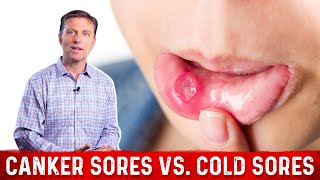 Canker Sores Vs Cold Sores – Dr Berg on Mouth Sores [upl. by Luigi]