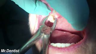 RealLife Tooth Extractions by Dentists [upl. by Neyut]