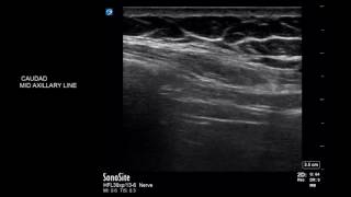 Diaphragmatic scanning using USG  ABCDE technique [upl. by Anaehs]