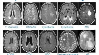 MRI Uses in MS [upl. by Rabma]