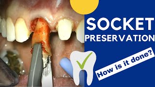 Tooth extraction and SOCKET PRESERVATION  How is it done [upl. by Affay]