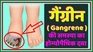 गैंग्रीन का होम्योपैथिक इलाज  Homeopathic Treatment For Gangrene [upl. by Neelra]