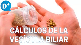 Causas y síntomas de los cálculos de la vesícula biliar [upl. by Amato490]