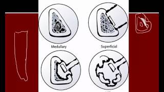 Osteomyelitis Acute and Chronic [upl. by Nellac]