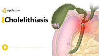 Cholelithiasis II  Gastroenterology Medicine Animation  Medical VLearning [upl. by Hadihsar186]