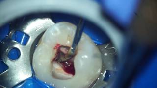 MTA pulpotomy on adult molar [upl. by Chaffinch145]